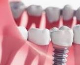 Article 33 - What Are the Perks of Choosing Dental Implants?