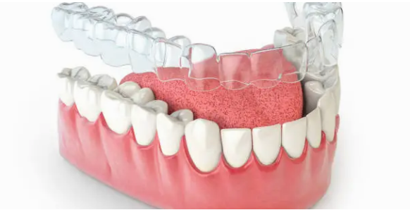 Invisalign Adelaide